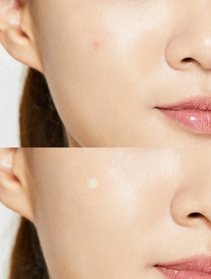 Acne Pimple Master Patch